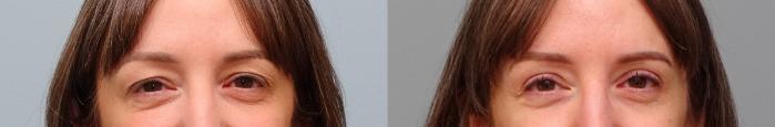 Before & After Eyelid Surgery Case 89 Front View in Anchorage, AK