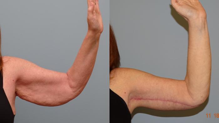 Before & After Arm Lift Case 76 Left Side View in Anchorage, AK
