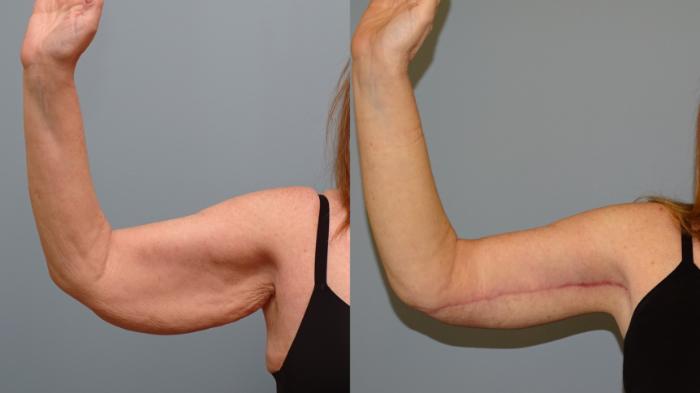 Before & After Arm Lift Case 76 Right Side View in Anchorage, AK