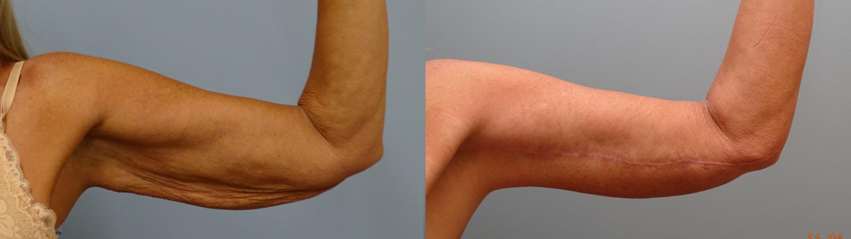 Before & After Arm Lift Case 83 Left Side View in Anchorage, AK