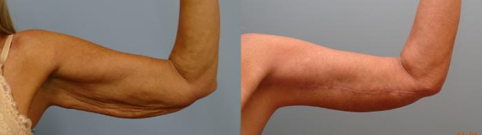 Before & After Arm Lift Case 83 Left Side View in Anchorage, AK