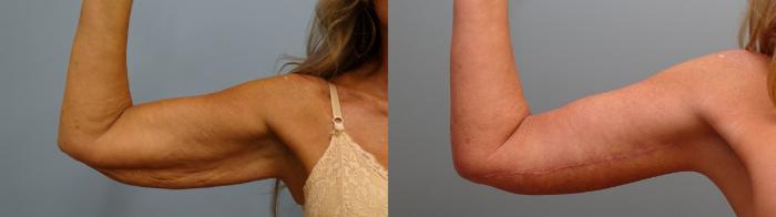 Before & After Arm Lift Case 83 Right Side View in Anchorage, AK