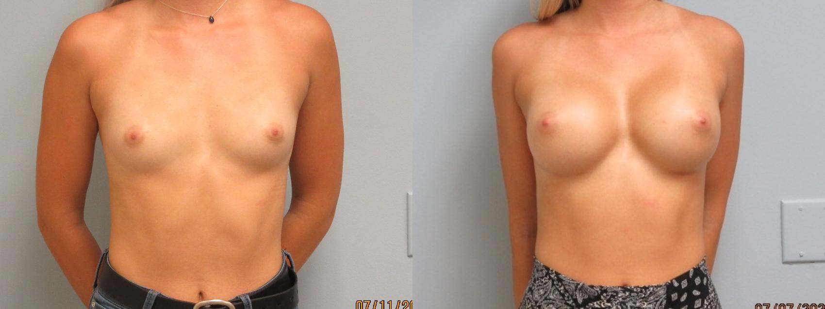 Before & After Breast Augmentation Case 12 Front View in Anchorage, AK