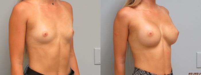 Before & After Breast Augmentation Case 12 Right Oblique View in Anchorage, AK