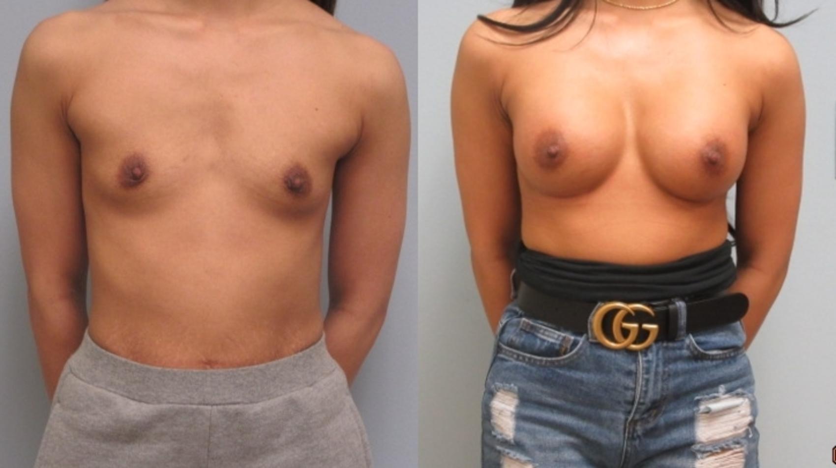 Before & After Breast Augmentation Case 14 Front View in Anchorage, AK