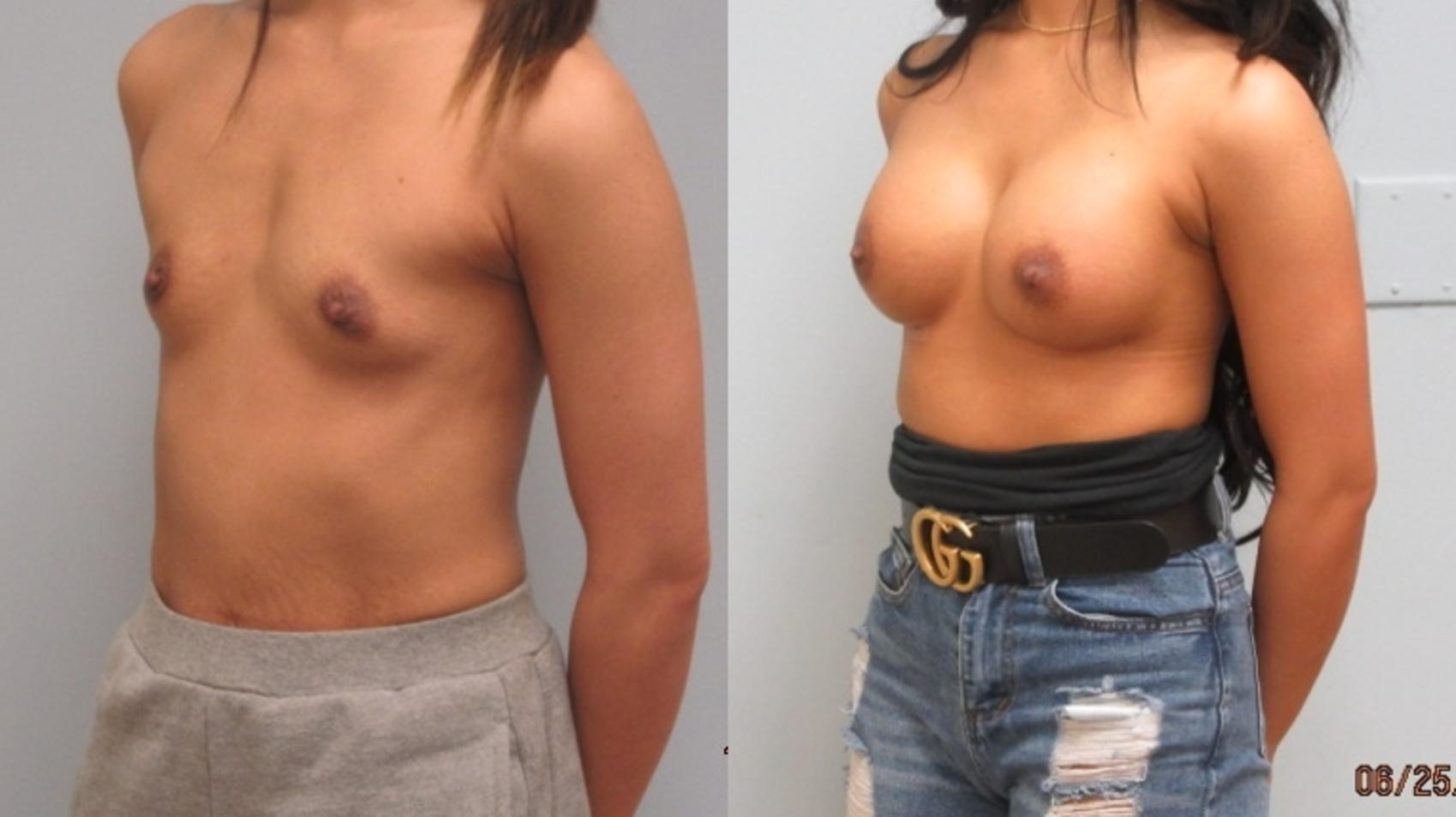 Before & After Breast Augmentation Case 14 Left Side View in Anchorage, AK