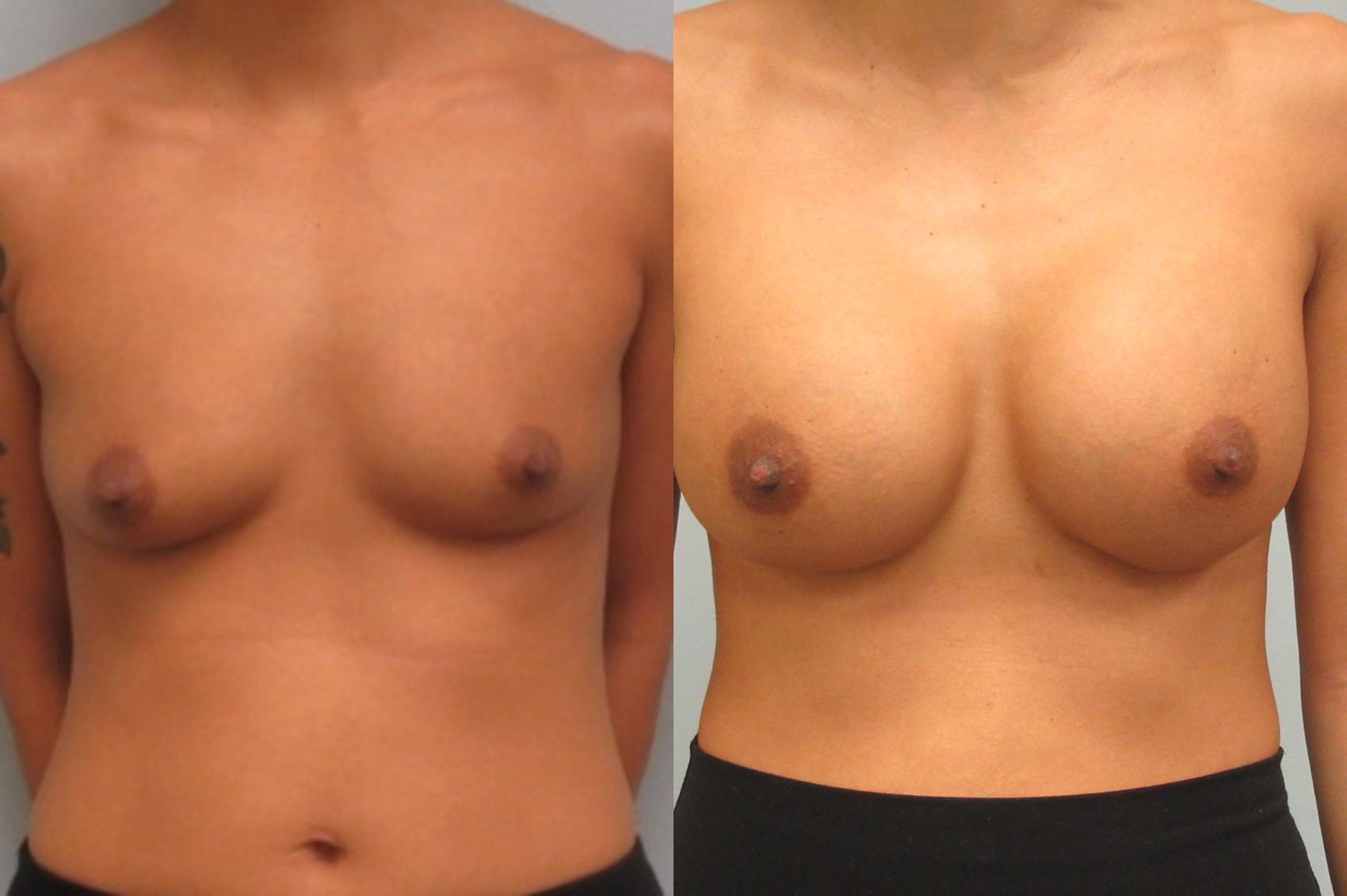 Before & After Breast Augmentation Case 20 Front View in Anchorage, AK