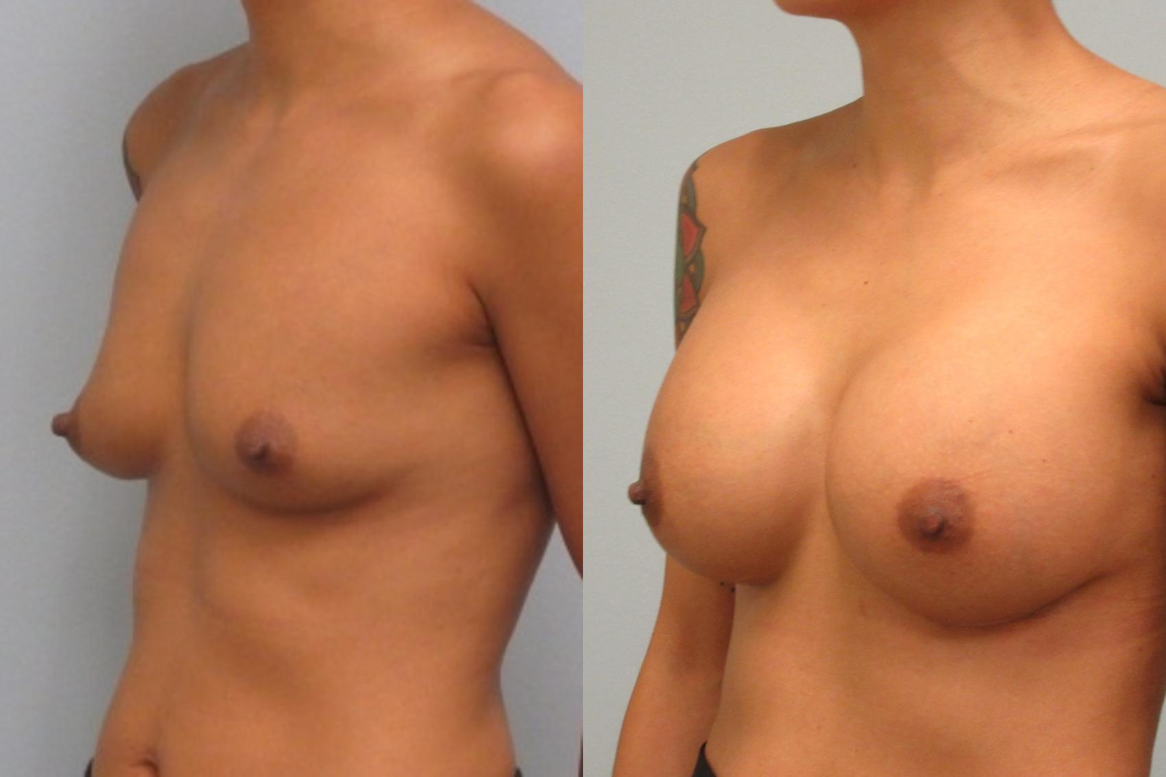 Before & After Breast Augmentation Case 20 Left Oblique View in Anchorage, AK