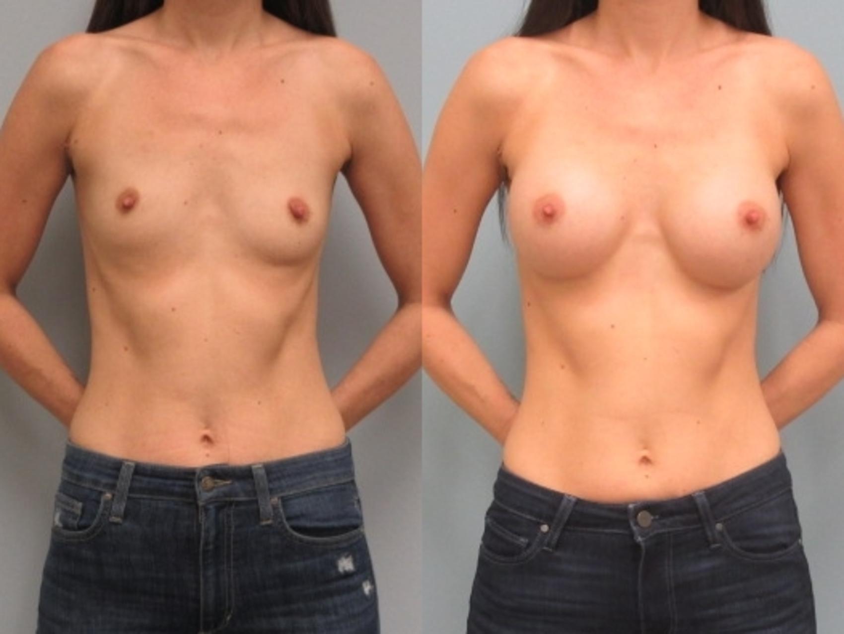 Before & After Breast Augmentation Case 25 Front View in Anchorage, AK