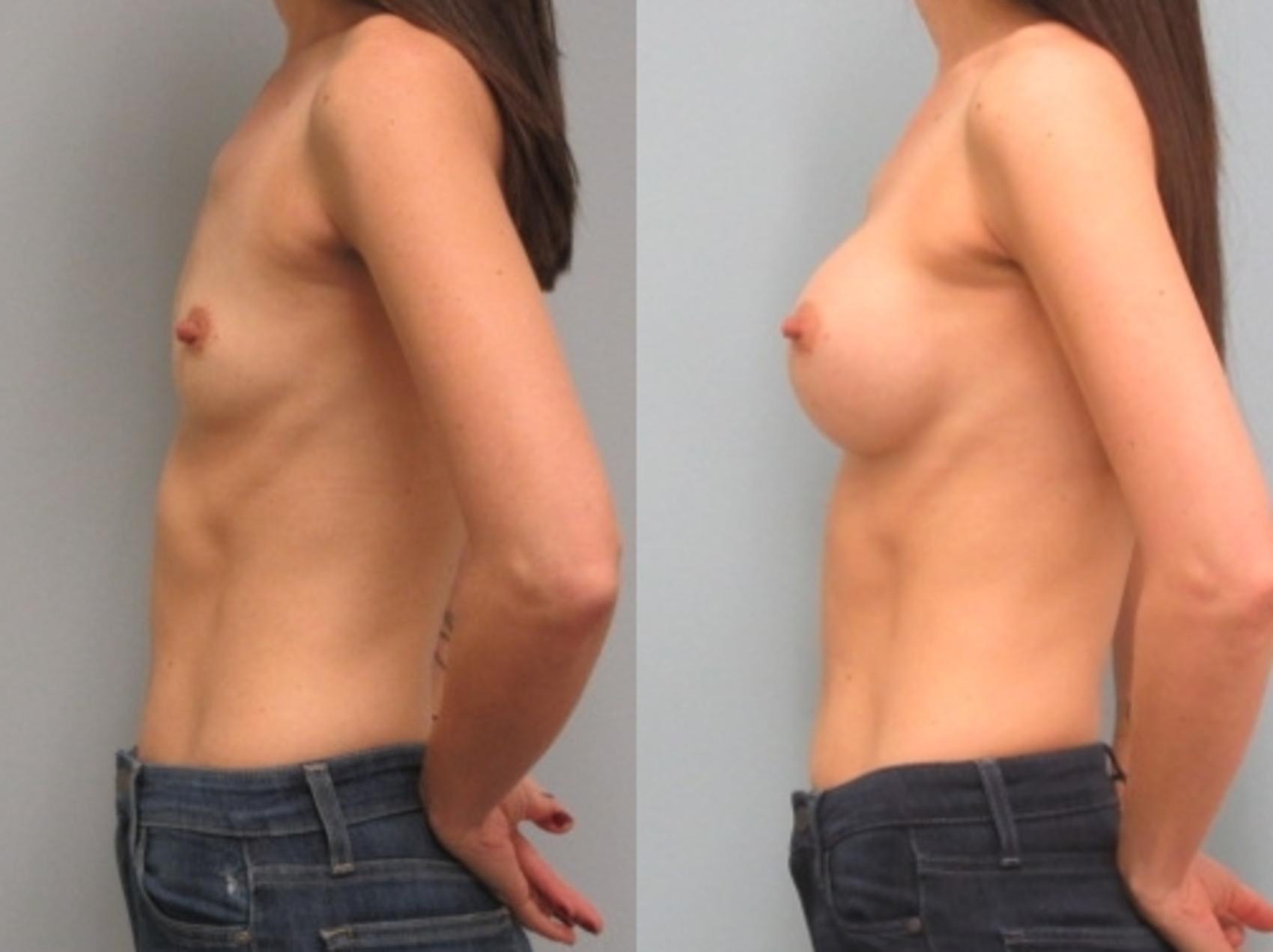 Before & After Breast Augmentation Case 25 Left Side View in Anchorage, AK
