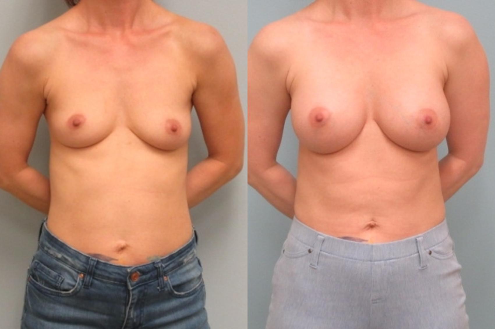 Before & After Breast Augmentation Case 28 Front View in Anchorage, AK