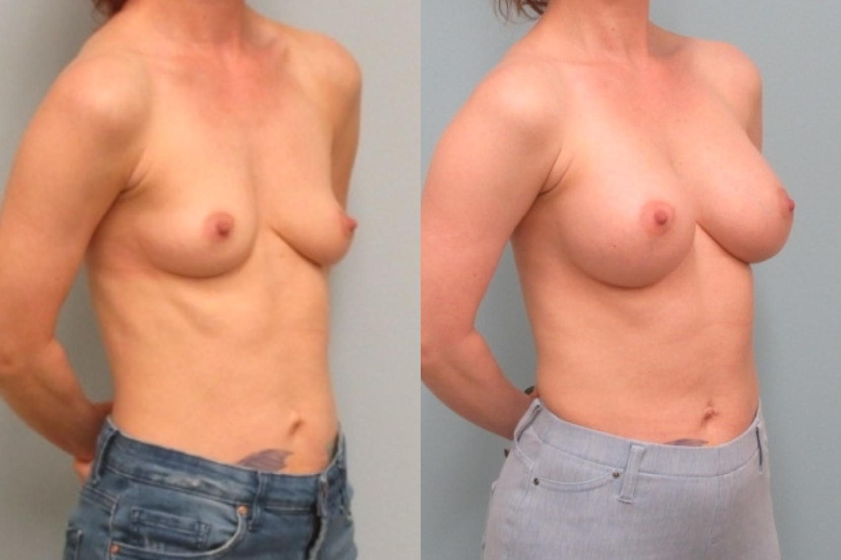 Before & After Breast Augmentation Case 28 Right Oblique View in Anchorage, AK