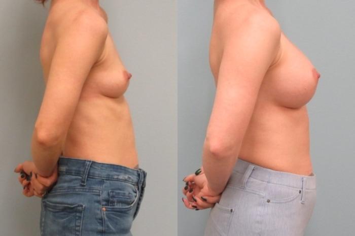 Before & After Breast Augmentation Case 28 Right Side View in Anchorage, AK