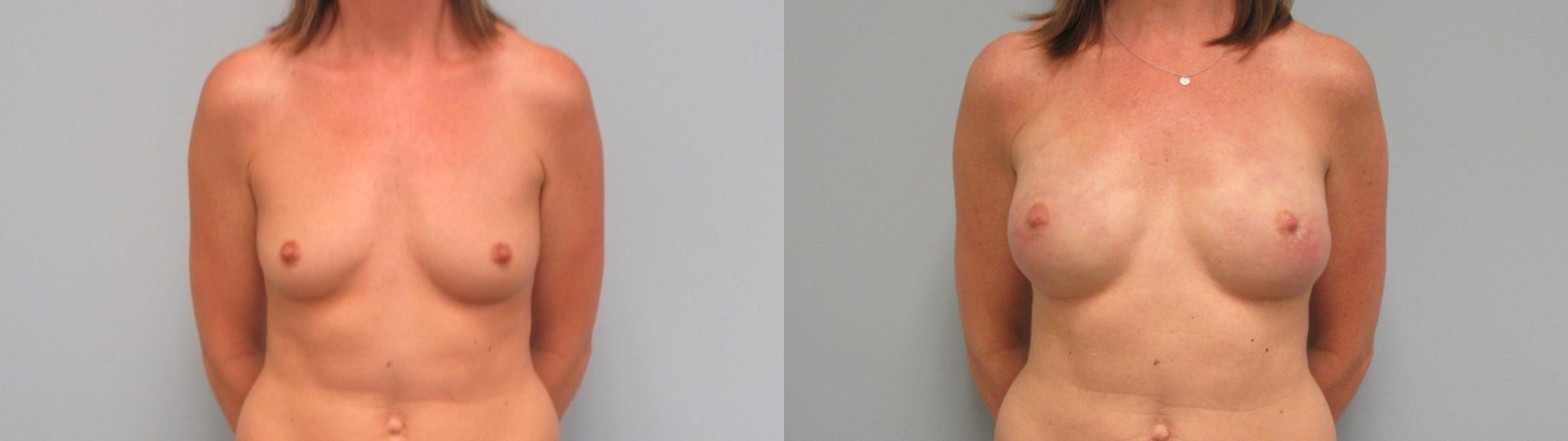 Before & After Breast Augmentation Case 3 Front View in Anchorage, AK