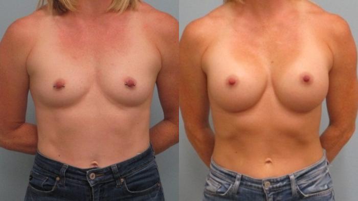 Before & After Breast Augmentation Case 30 Front View in Anchorage, AK