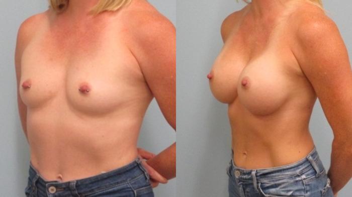 Before & After Breast Augmentation Case 30 Left Oblique View in Anchorage, AK