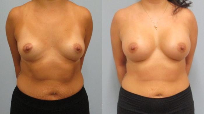 Before & After Breast Augmentation Case 31 Front View in Anchorage, AK