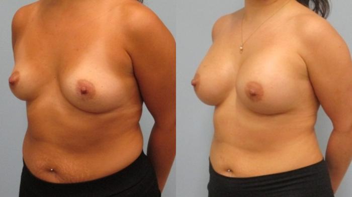 Before & After Breast Augmentation Case 31 Left Oblique View in Anchorage, AK