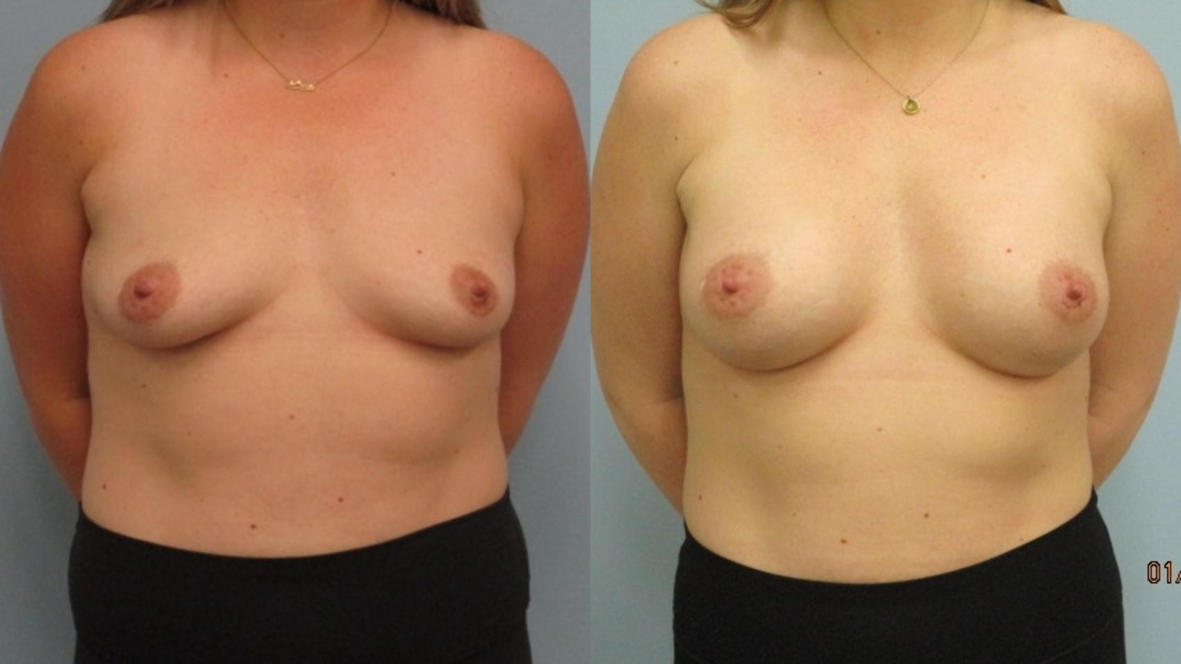 Before & After Breast Augmentation Case 42 Front View in Anchorage, AK