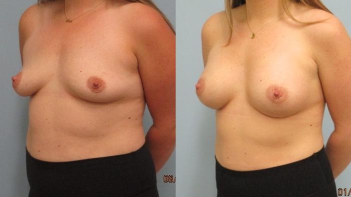 Before & After Breast Augmentation Case 42 Left Oblique View in Anchorage, AK