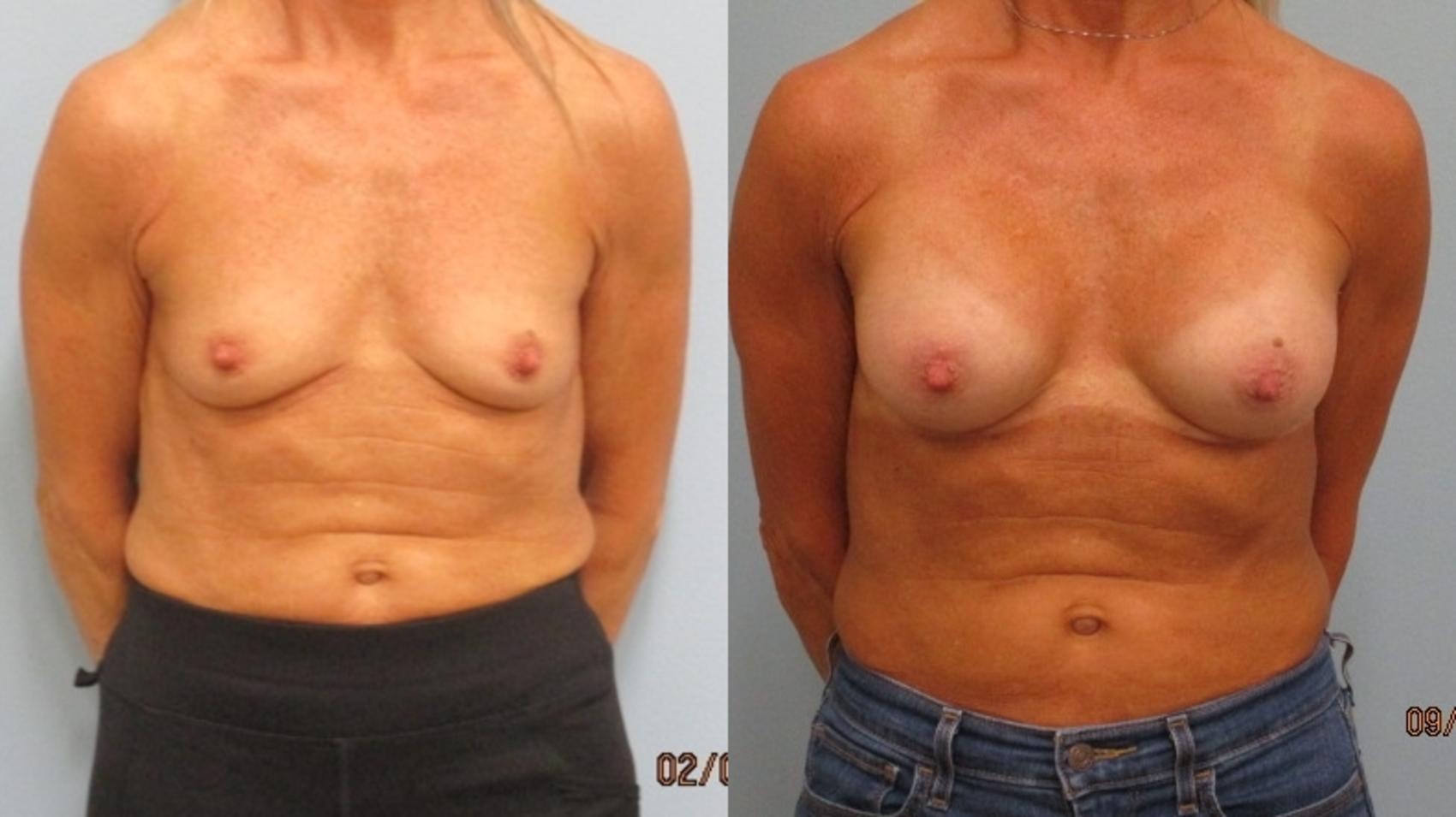 Before & After Breast Augmentation Case 43 Front View in Anchorage, AK
