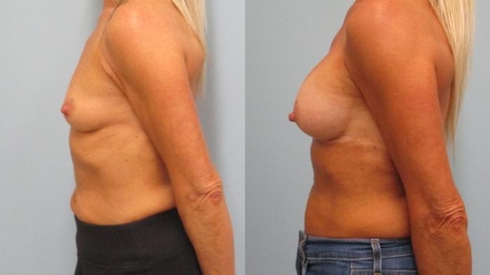 Before & After Breast Augmentation Case 43 Left Side View in Anchorage, AK