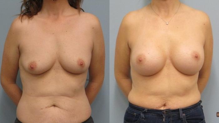 Before & After Breast Augmentation Case 46 Front View in Anchorage, AK
