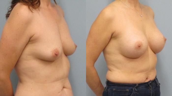 Before & After Breast Augmentation Case 46 Right Oblique View in Anchorage, AK