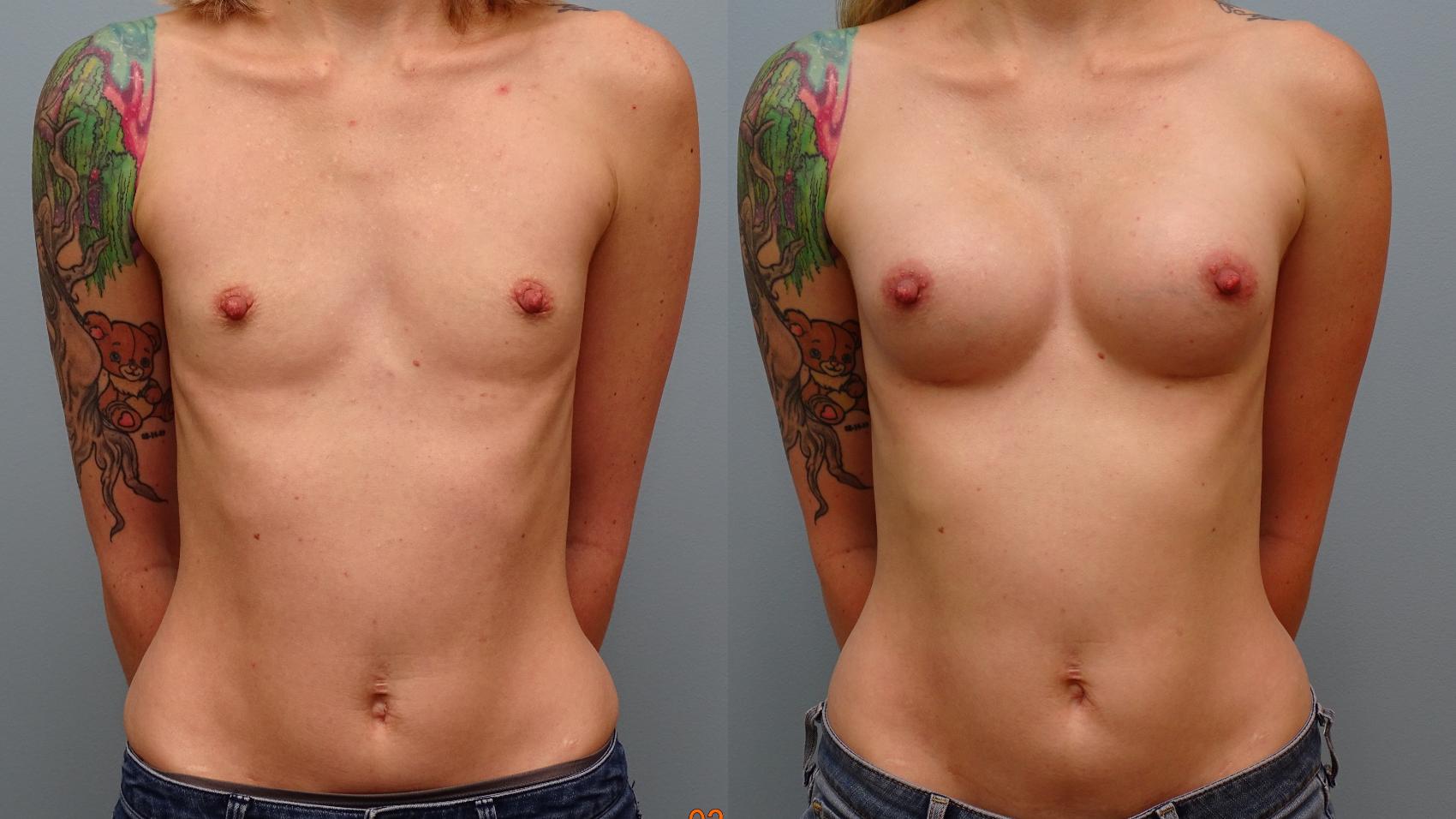 Before & After Breast Augmentation Case 57 Front View in Anchorage, AK