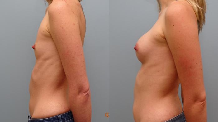 Before & After Breast Augmentation Case 57 Left Side View in Anchorage, AK