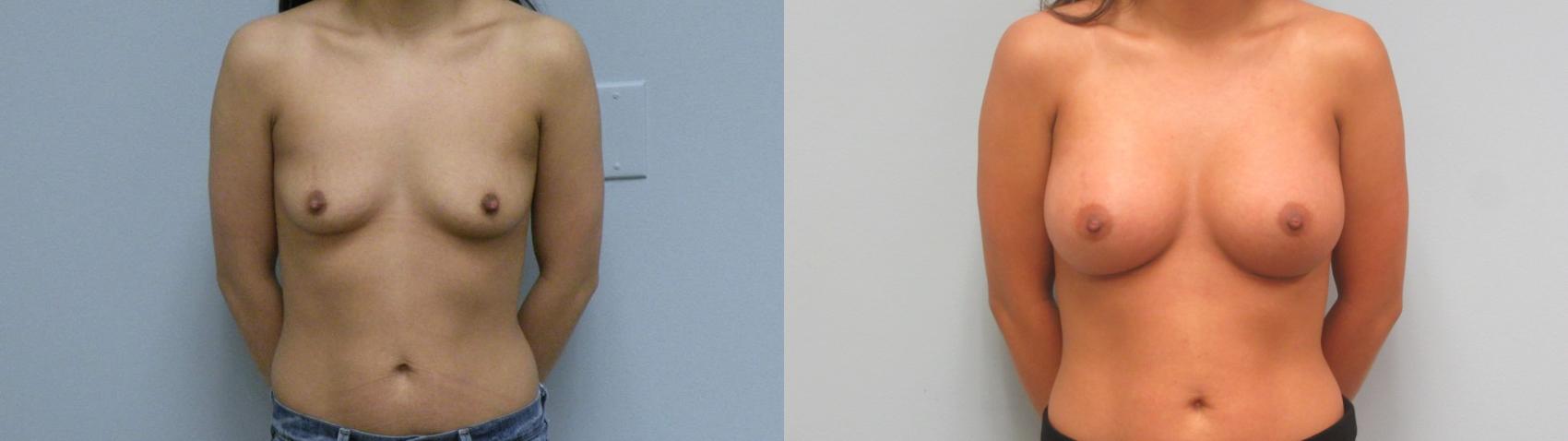 Before & After Breast Augmentation Case 6 Front View in Anchorage, AK