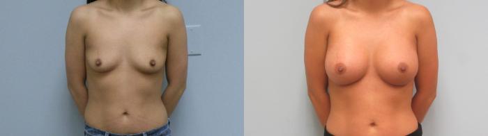 Before & After Breast Augmentation Case 6 Front View in Anchorage, AK