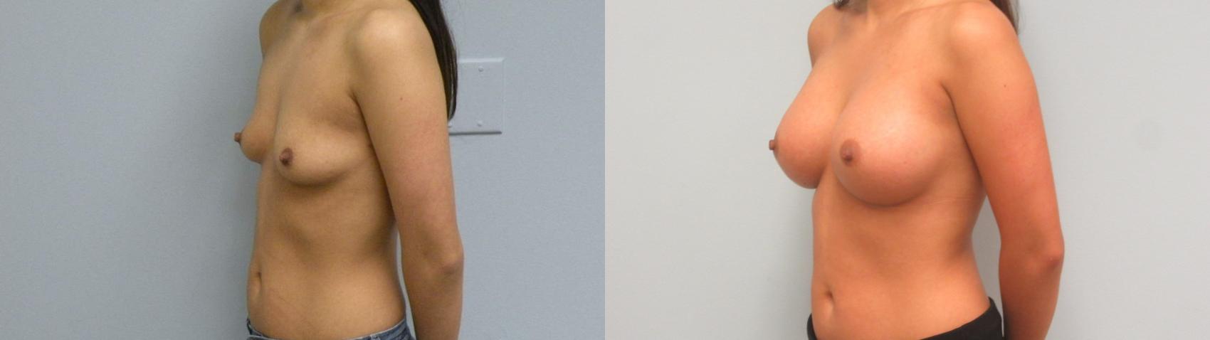 Before & After Breast Augmentation Case 6 Left Oblique View in Anchorage, AK