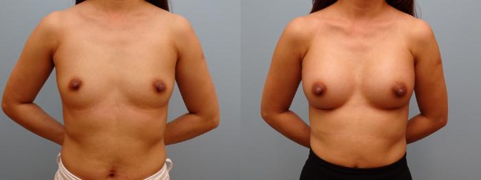Before & After Breast Augmentation Case 60 Front View in Anchorage, AK