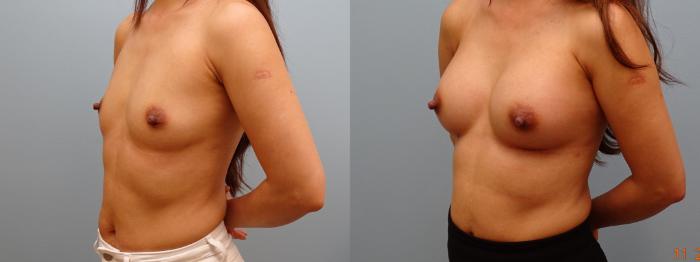 Before & After Breast Augmentation Case 60 Left Oblique View in Anchorage, AK