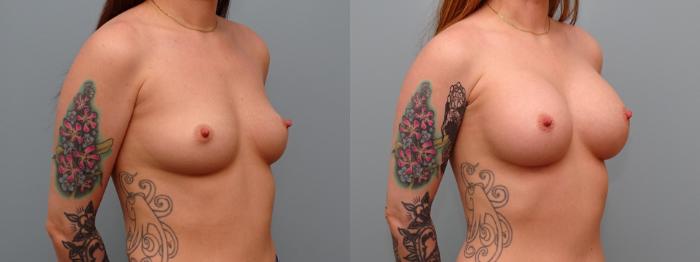 Before & After Breast Augmentation Case 61 Right Oblique View in Anchorage, AK