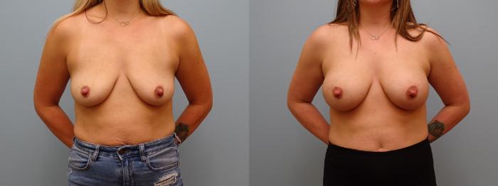 Before & After Breast Augmentation Case 62 Front View in Anchorage, AK