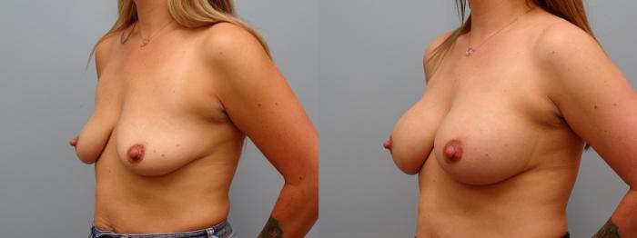 Before & After Breast Augmentation Case 62 Left Oblique View in Anchorage, AK