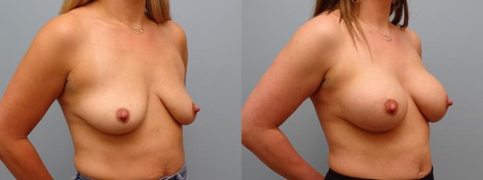 Before & After Breast Augmentation Case 62 Right Oblique View in Anchorage, AK