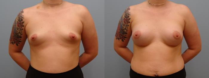 Before & After Breast Augmentation Case 63 Front View in Anchorage, AK