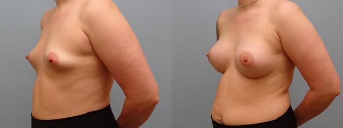 Before & After Breast Augmentation Case 63 Left Oblique View in Anchorage, AK