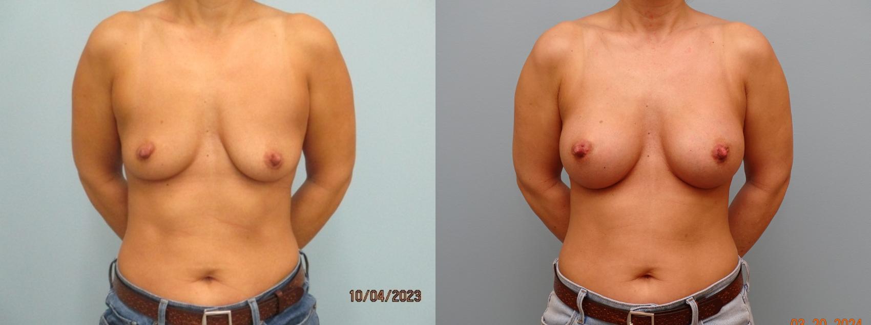 Before & After Breast Augmentation Case 71 Front View in Anchorage, AK