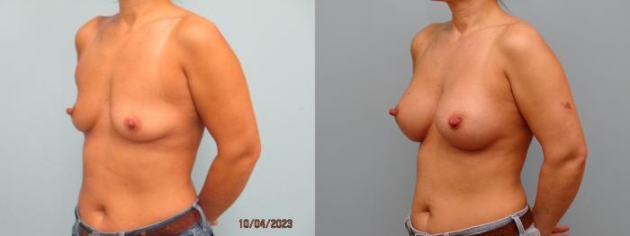 Before & After Breast Augmentation Case 71 Left Oblique View in Anchorage, AK