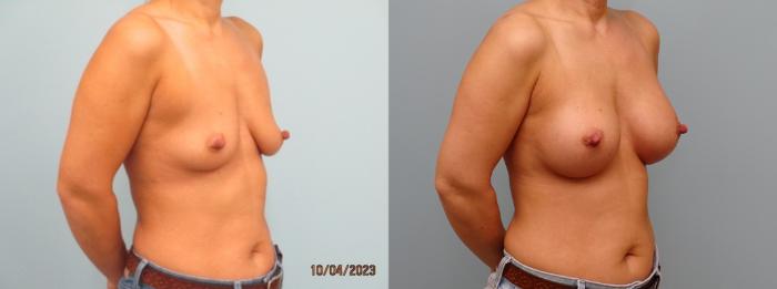 Before & After Breast Augmentation Case 71 Right Oblique View in Anchorage, AK