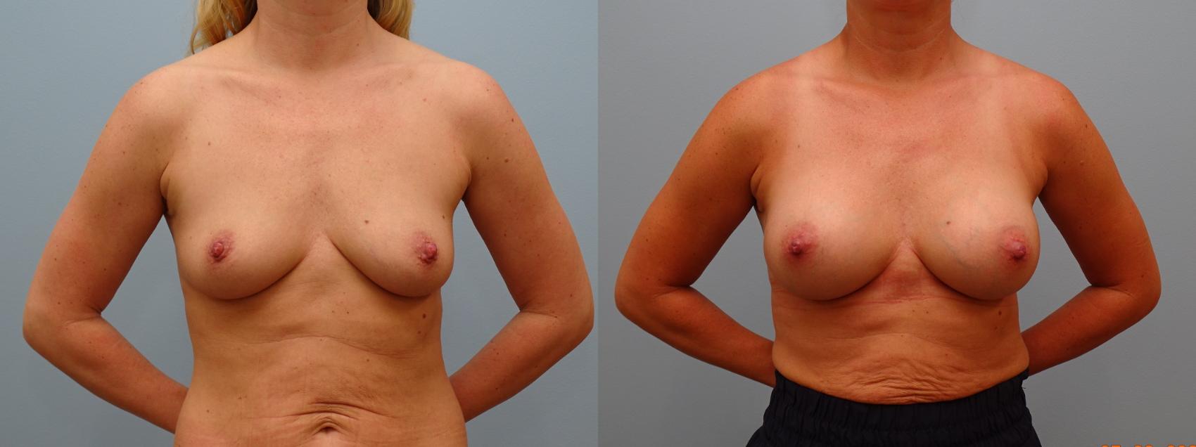 Before & After Breast Augmentation Case 73 Front View in Anchorage, AK