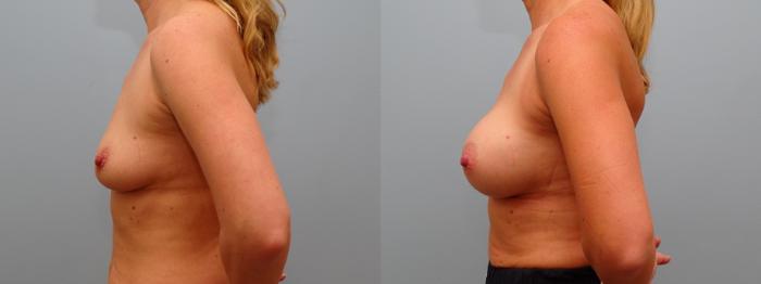 Before & After Breast Augmentation Case 73 Left Side View in Anchorage, AK