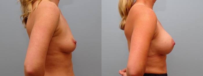 Before & After Breast Augmentation Case 73 Right Side View in Anchorage, AK