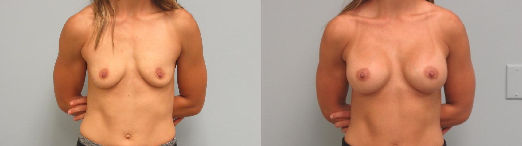 Before & After Breast Augmentation Case 8 Front View in Anchorage, AK