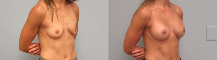 Before & After Breast Augmentation Case 8 Right Oblique View in Anchorage, AK