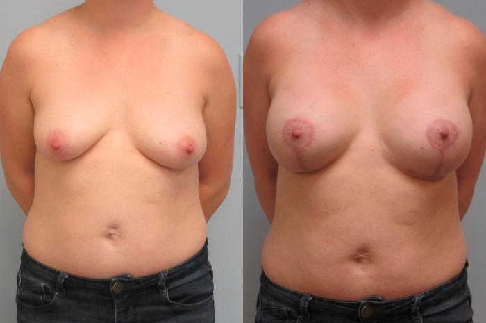 Before & After Breast Augmentation with Breast Lift  Case 22 Front View in Anchorage, AK